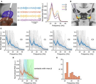 Subthalamic high-beta oscillation informs the outcome of deep brain stimulation in patients with Parkinson's disease